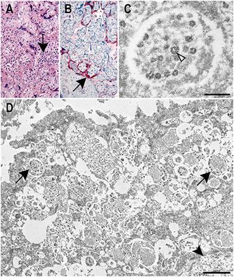 Probable vertical transmission of Alpha variant of concern (B.1.1.7) with evidence of SARS-CoV-2 infection in the syncytiotrophoblast, a case report